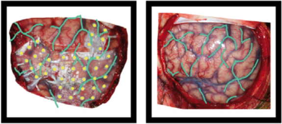 operative photo of ECoG electrodes operative photo of ECoG electrodes