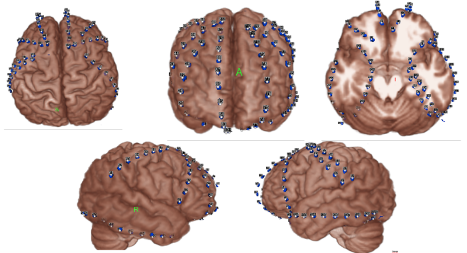 volume rendering of the cortical surface volume rendering of the cortical surface