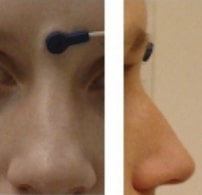 placement of NAS fiducial placement of NAS fiducial
